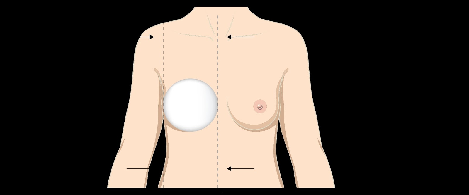 diagram of natural breast implant size