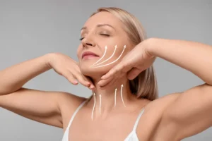 facelift diagram