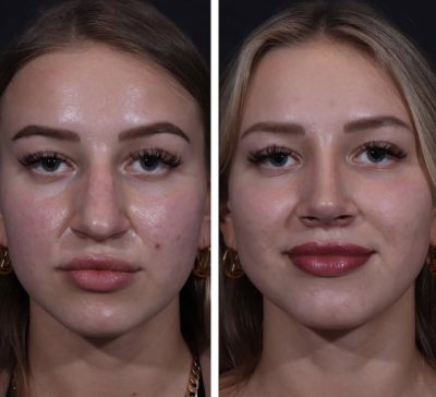 Before and After photos of Bulbous Tip Rhinoplasty